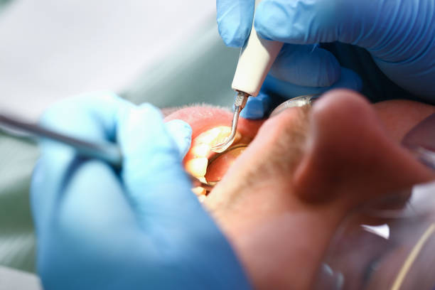 Best Emergency Wisdom Teeth Removal in Montecito, CA